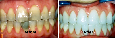 Before and After Porcelain-Veneers