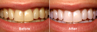Before and After Teeth-Whitening
