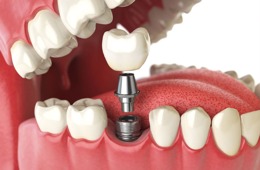 Dental Implants and Restoration