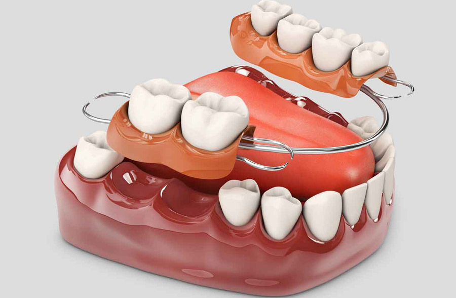 Partial and full dentures