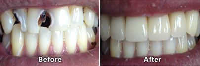 Before and After Porcelain Crowns