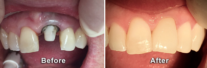 Before and After Porcelain Crowns
