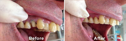 Before and After Cerec