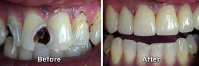 Before and After Cerec