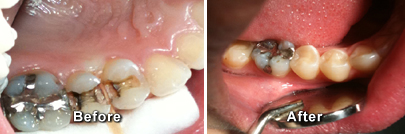 Before and After Tooth Colored Fillings
